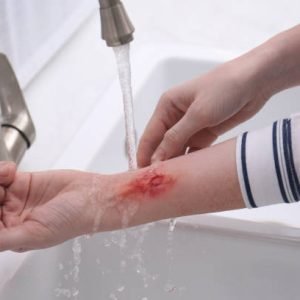Woman holding forearm with burn under flowing water indoors, closeup